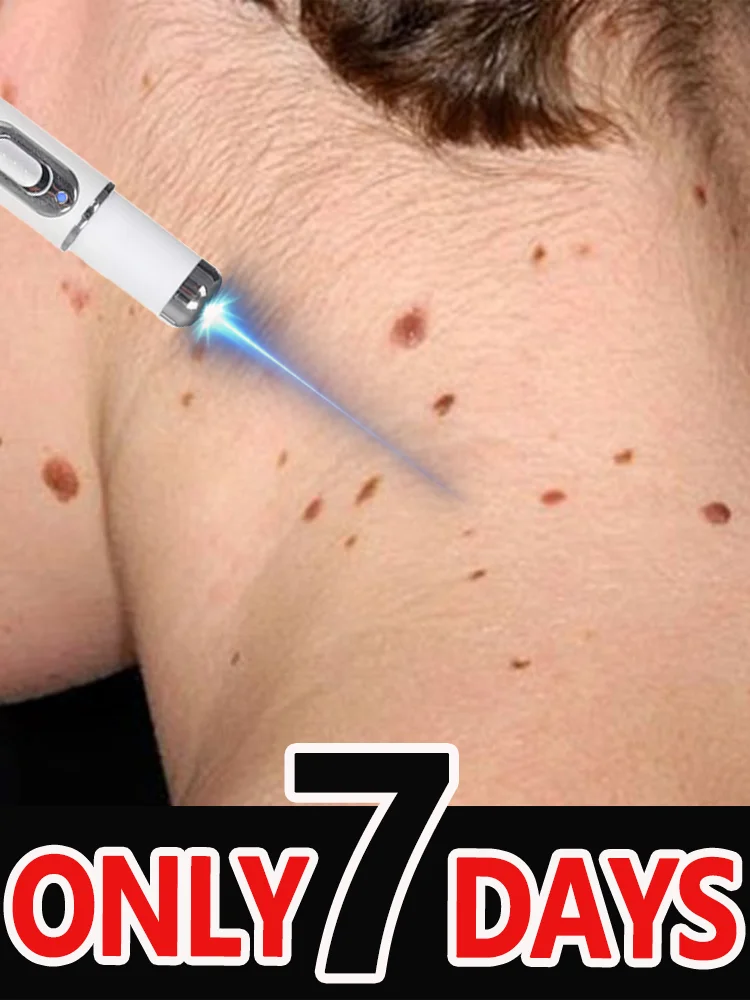 Warts blue light tool, more discounts on sets