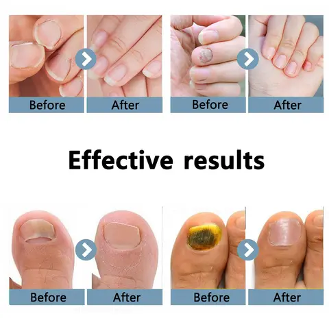 10 best sales फंगस नाखून उपचार - №7