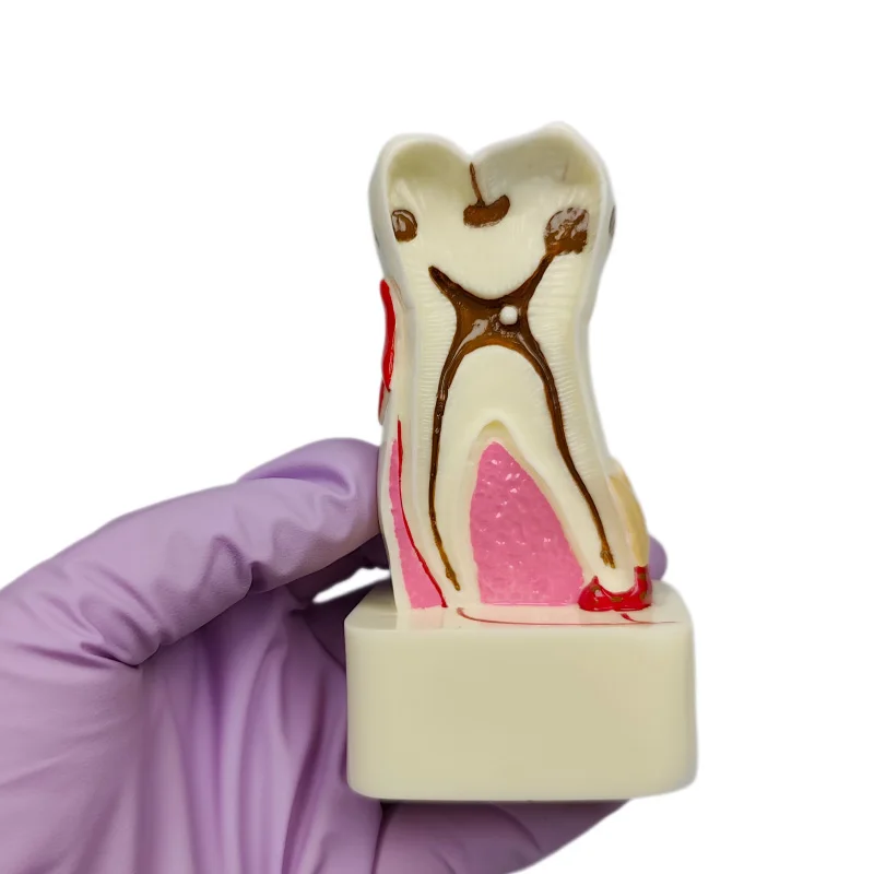 4X Enlarged Pathological Tooth Model M4015 Periodontal Disease Communication&Patient Education Model Dental Teaching Teeth Model