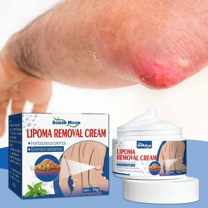 50g Lipoma Removal Cream The Whole Body Multiple Subcutaneous Conditioning Cream Eliminate Paste Fiber Paste Skin Care