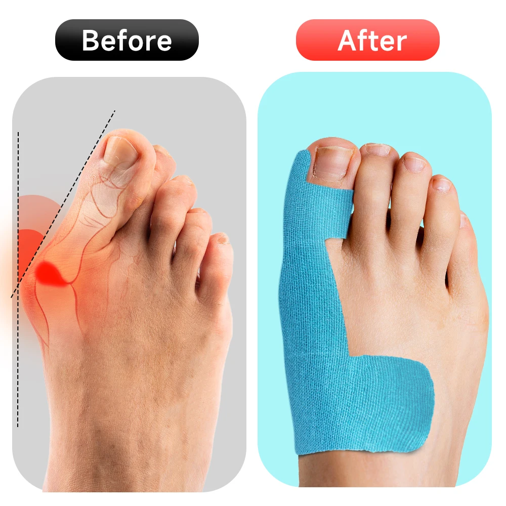 10/20PC Kinesiology Athletic Tape for Bunion Big Toe Separator Foot Straightener Tape,Protective Tape Toe Corrector Straightener