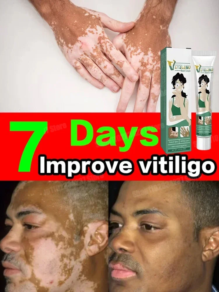 Effective vitiligo repair cream and white spot lightening product 1