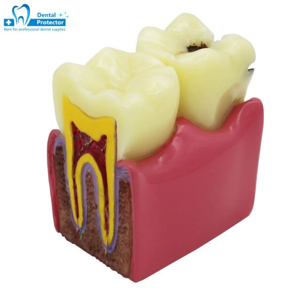 

Dental Teeth model 6 Times Caries Study Denture Tooth Models Dentist Studying Researching 6 Times Dental Caries Comparison Model