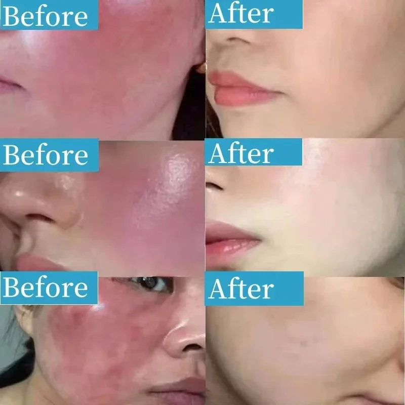 Reparar vermelhidão facial soro instantâneo aranha veia remover pele sensível calmar anti vermelhidão rosacea tratar loção cosméticos coreanos