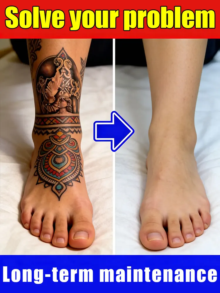 

Для удаления цветных перманентных татуировок, удаления татуировок