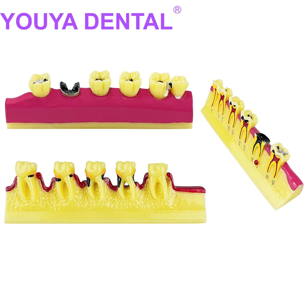 

Teeth Periodontal Disease Model Dental Teeth Model Dentistry Teaching Study Education Typodont Dentist Display Communication Too