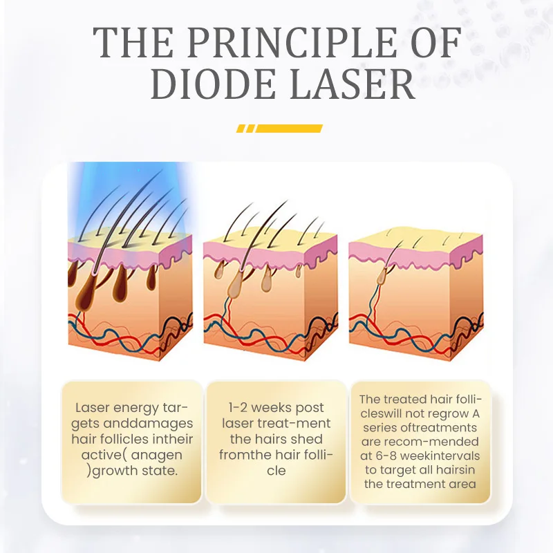 2026 Professional New Product Doide Laser Doide 808 755 1064 Diode Laser Removal Machine Diode Laser 808 Hair Removal Machine view 4