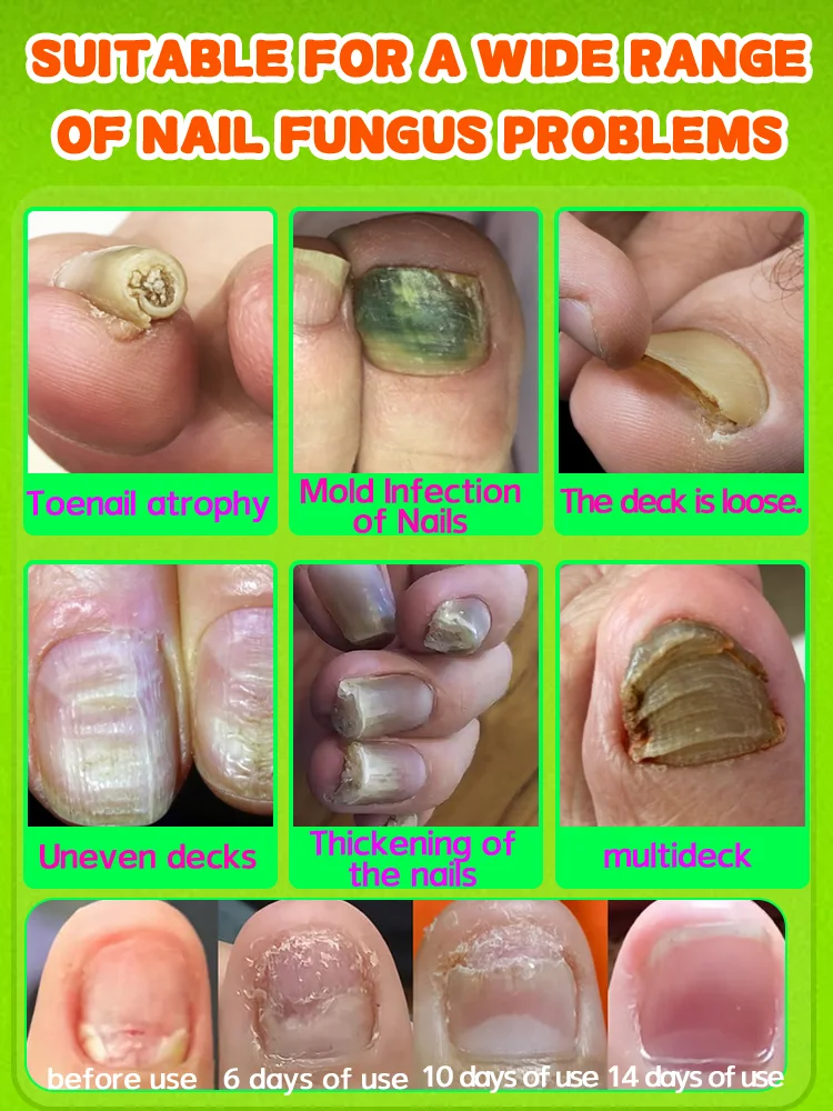 Las uñas pasan de estar opacas a transparentes. El spray para hongos en las uñas es testigo del milagro.