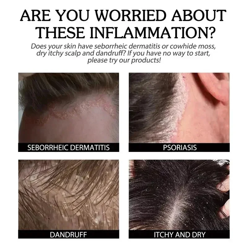 علاج فروة الرأس جوهر رذاذ القشرة الحكة السيطرة على النفط مكافحة فقدان فروة الرأس تنظيف إصلاح مصل منتجات العناية بالشعر الجمال