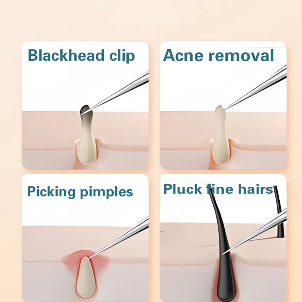 مجموعة إبر إزالة حب الشباب من الفولاذ المقاوم للصدأ حادة للغاية، مزيل الرؤوس السوداء، مجموعة أدوات استخلاص حب الشباب المحددة في صالونات التجميل #3