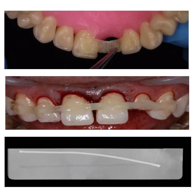 Tiras de fibra Flexible para fijación Dental, retenedores de ortodoncia para fijación de dientes sueltos, 3 piezas