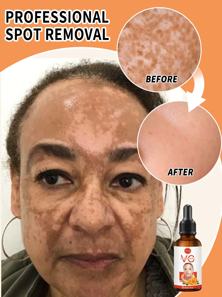 

Whitening and anti-freckle essential oil lightens dark spots, removes yellowness and brightens