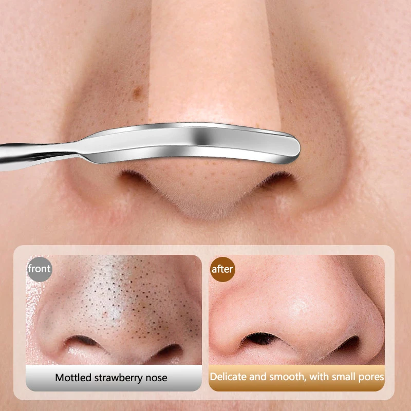 1 ชิ้นสแตนเลสสตีล Blackhead Remover สิวเครื่องมือเข็มสิวถอด Treatment Whitehead Zit จมูก Blemish Extractor เครื่องมือ