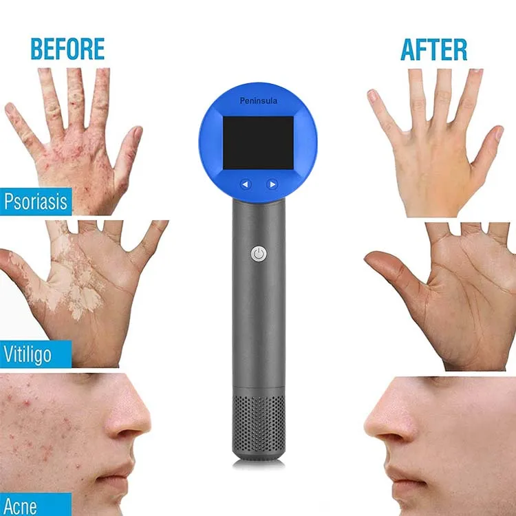 

Peninsula Psoriasis Vitiligo Treatment LED Phototherapy Lamp Excimer Laser 308nm Psoriasis For Skin Diseseas Phototherapy