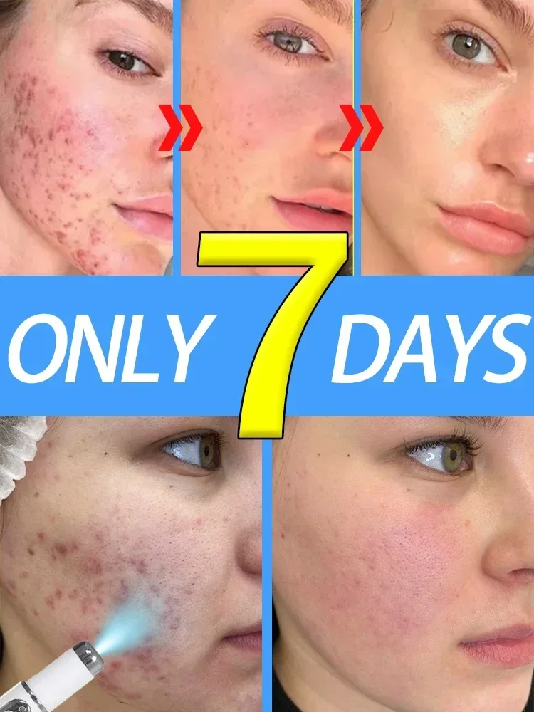 

acne scar treatment acne serum