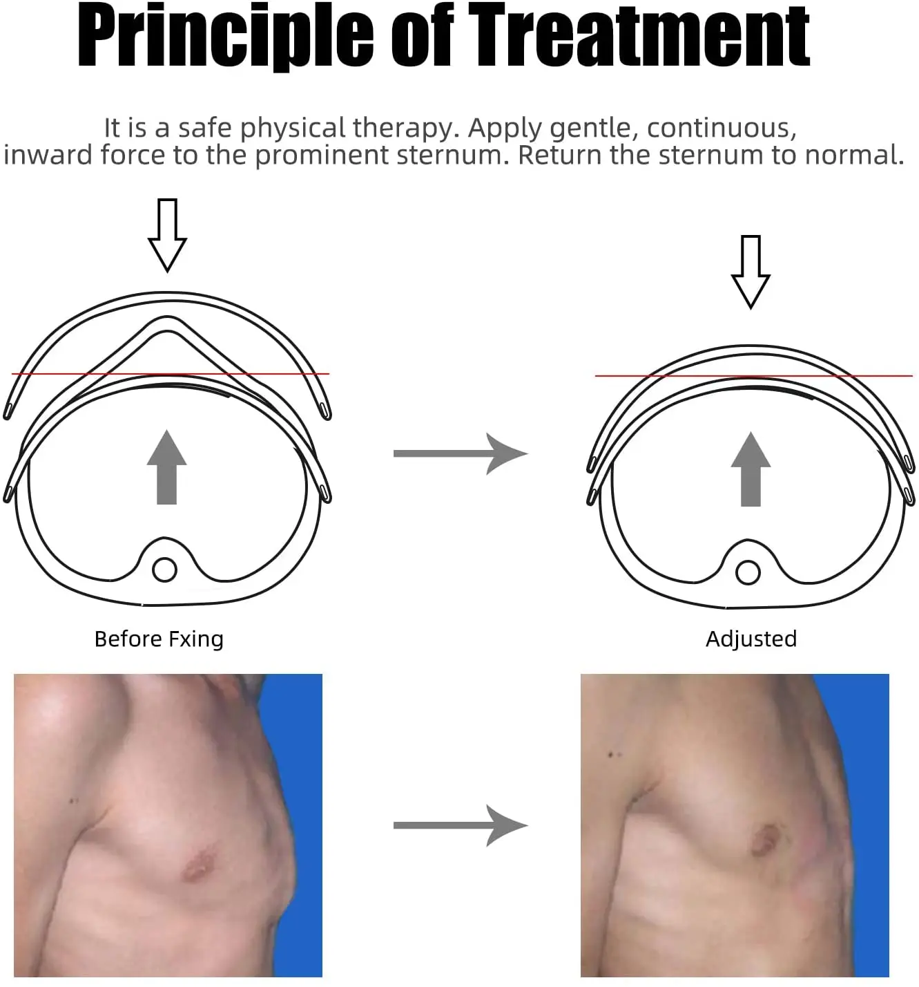 Tutore per ortesi Pectus Carinatum, tutore per ortesi valgo per costole correttore per il seno con regolatore di dimensioni