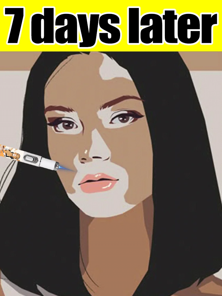 

Generation-1 Laser Says Goodbye To Vitiligo In 7 Days