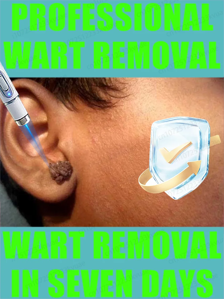 

Generation-2 Laser Says Goodbye To all warts In 7 Days