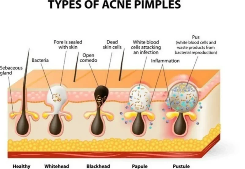 Neus Mee-Eter Verwijderaar Masker Diepe Reiniging Huidverzorging Krimp Porie Acne Behandelingsmasker Neus Zwarte Stippen Porie Strips 50 Stuks