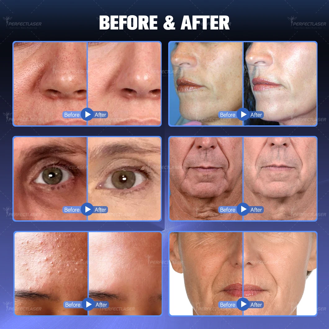 Perfectlaser 10 w 1 Hydro Maszyna Tlenowa Hydra Dermabrazja Twarz Odmładzanie Skóry Usuwanie Trądziku Zmniejszanie Pór Urządzenie