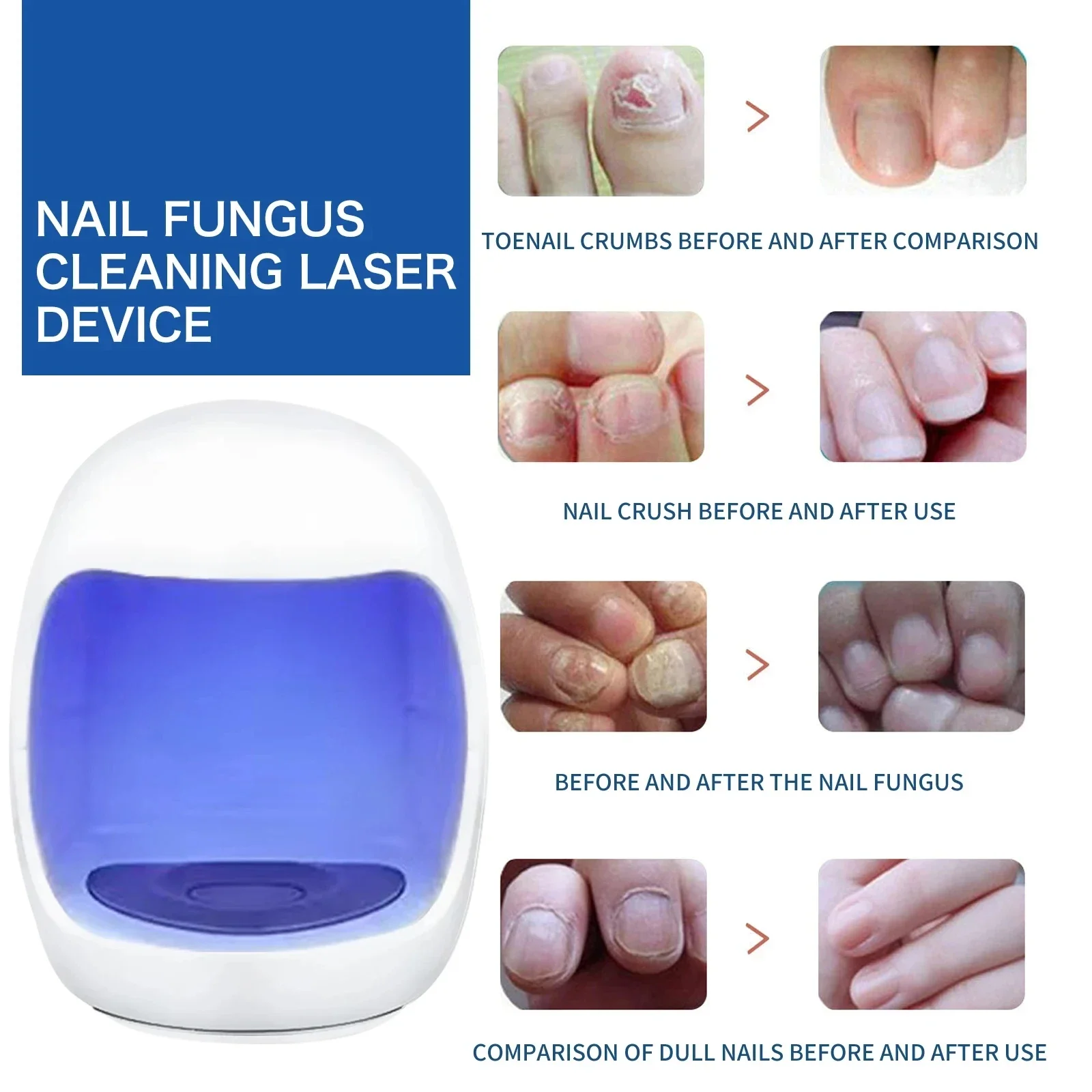 Dispositivo de tratamento do fungo do prego, Unhas do pé, Soro de reparação fúngica, Anti infecção, Unhas cinzentas, Onicomicose, Paroníquia Remover Ferramentas