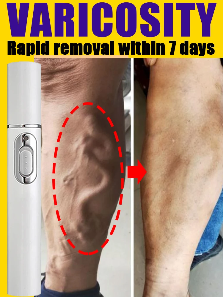 

Varicose vein treatment device Effective relief of dilated vasculitis phlebitis in legs Varicose vein formula ointment