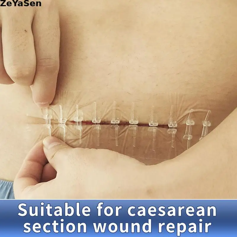 

10 шт., пластыри на молнии, без швов, пластыри для перевязки на рану, безболезненное устройство для закрытия ран, редуктор швов на молнии, водонепроницаемые полоски