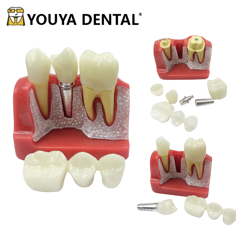 4 Times Dental Implant Model Crown Bridge Removable Porcelain Teeth Model for Dentist Teaching Model Science Study