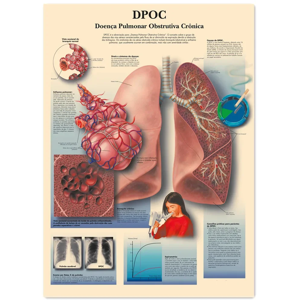 COPD Chronic Obstructive Pulmonary Disease Vintage Kraft Paper Wall Art Painting Human Anatomy Medical Posters & Prints Stickers