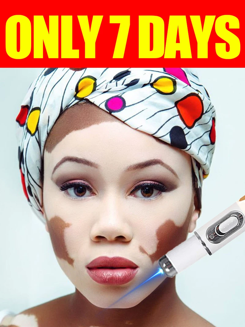 

Generation-2 Laser Says Goodbye To Vitiligo In 7 Days