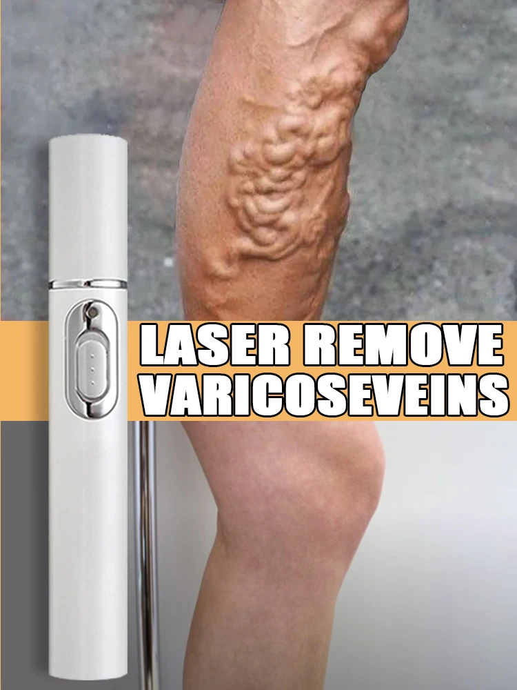 Spider leg laser vascular dredging pen