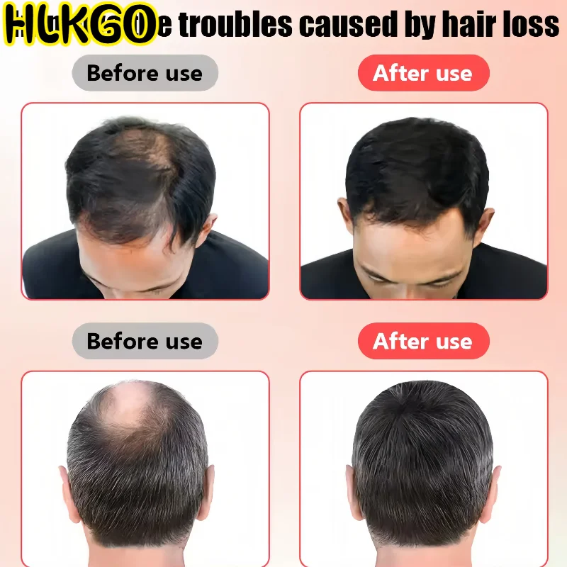 Laser Cap for Hair Growth 80 LEDs 650nm Red Light Therapy Cap for Effective Hair Regrowth and Scalp Health
