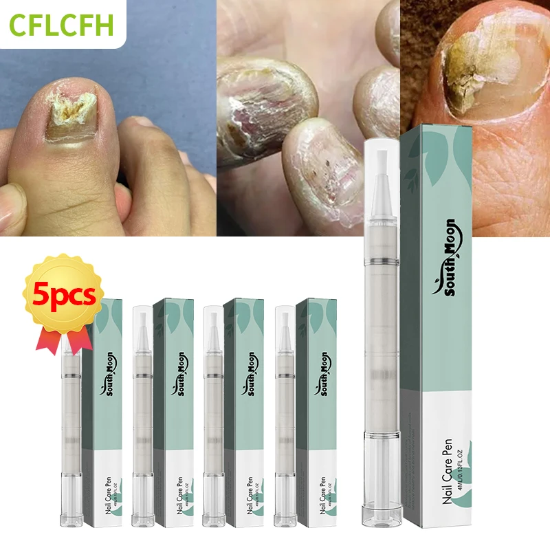 5 Pcs Nail Treatment Pen Anti Fungus Infection Cleaner Anti Fungal Nail Ingrown Correction Paronychia Repair Toenail Care Tool