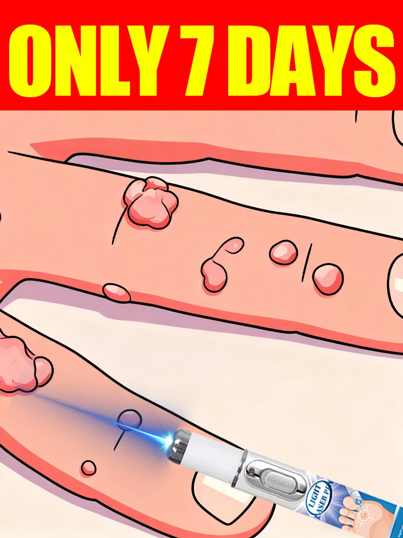 

Blue light pen solve all warts, wart care tools