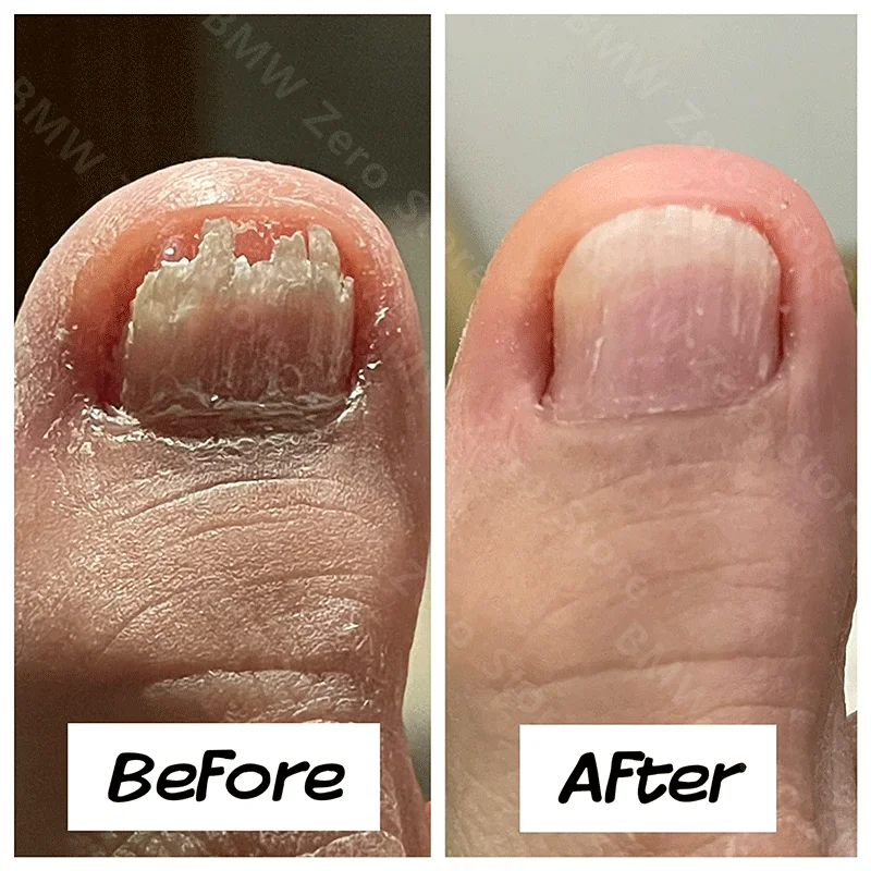 

NewToenail Nail Fungus Treatment Repair Fingernail Device Toenail Treatment for Foot Nail Fungus Essential Onychomycosis Ca