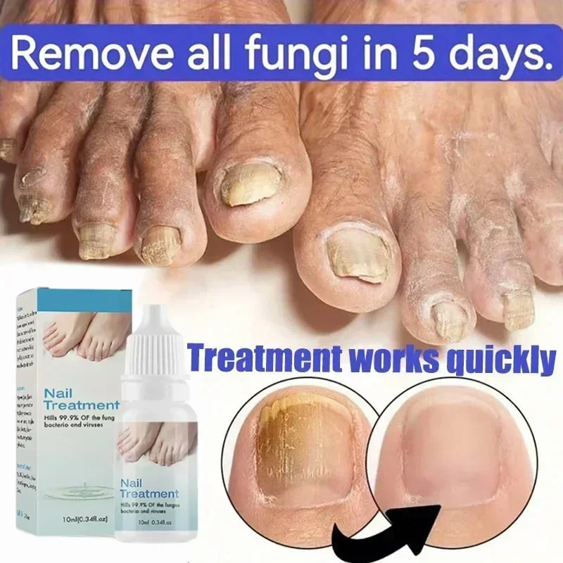 Anti infecção paroníquia onicomicose fungo nas unhas soro toe produtos de reparo fúngico mão cuidados com os pés remoção gel