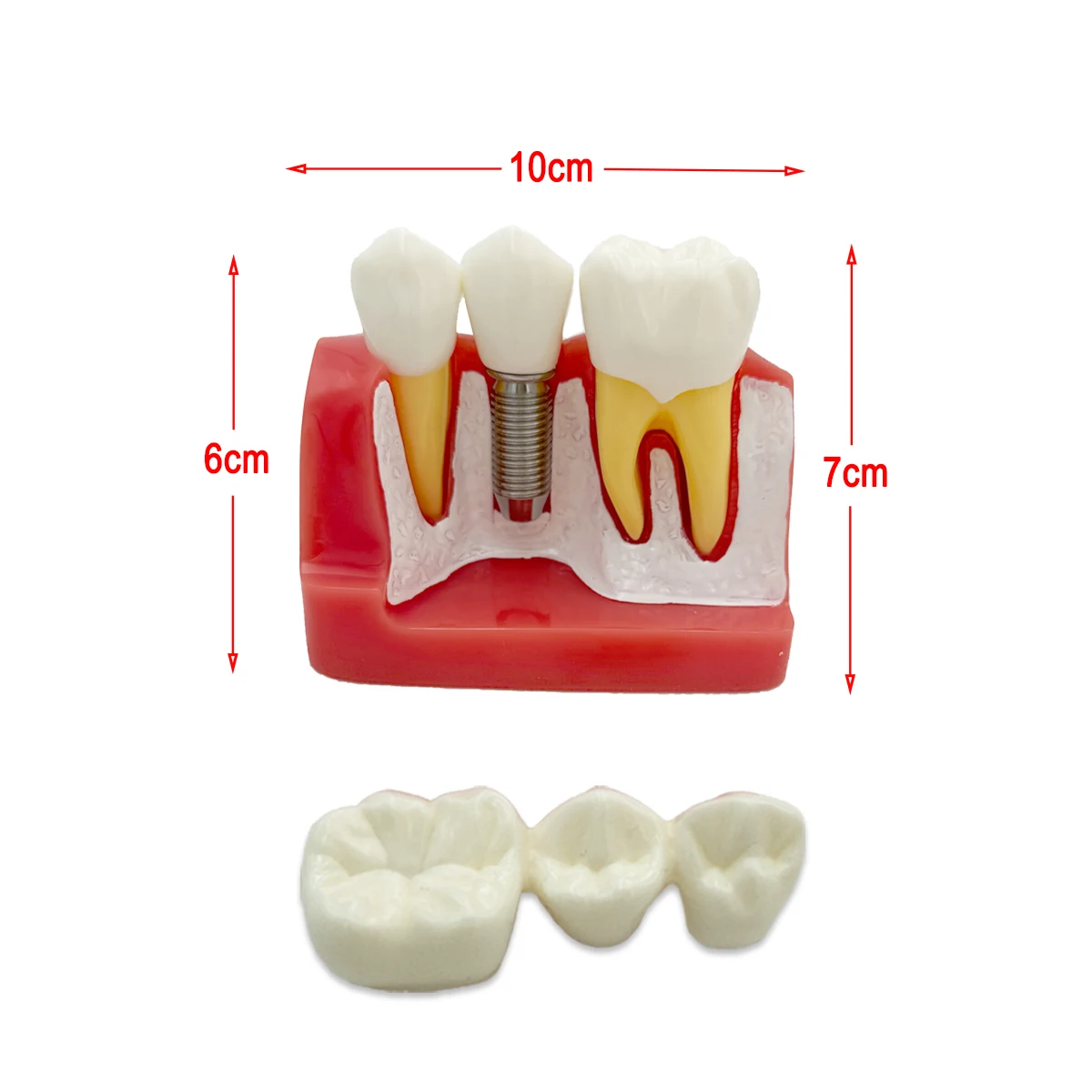 

Teeth Model Dental Teach Implant Analysis Crown Bridge Removable Models Dental Demonstration Teeth Model For Dentist Student