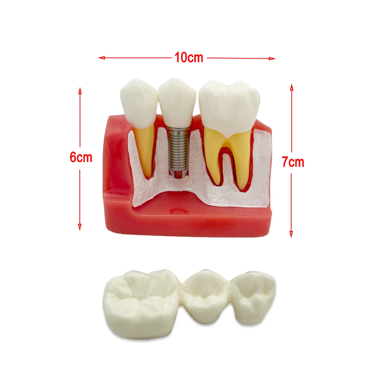 Teeth Model Dental Teach Implant Analysis Crown Bridge Removable Models Dental Demonstration Teeth Model For Dentist Student