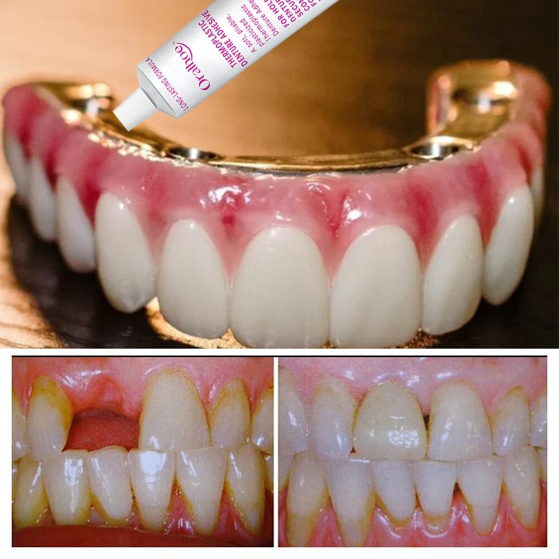 Thermoplastische kunstgebitlijm Langdurige kunstgebitbevestigingslijm Verbeter het comfort Kunstgebitverzorgingsproduct Odontologia Tandheelkundige zorg