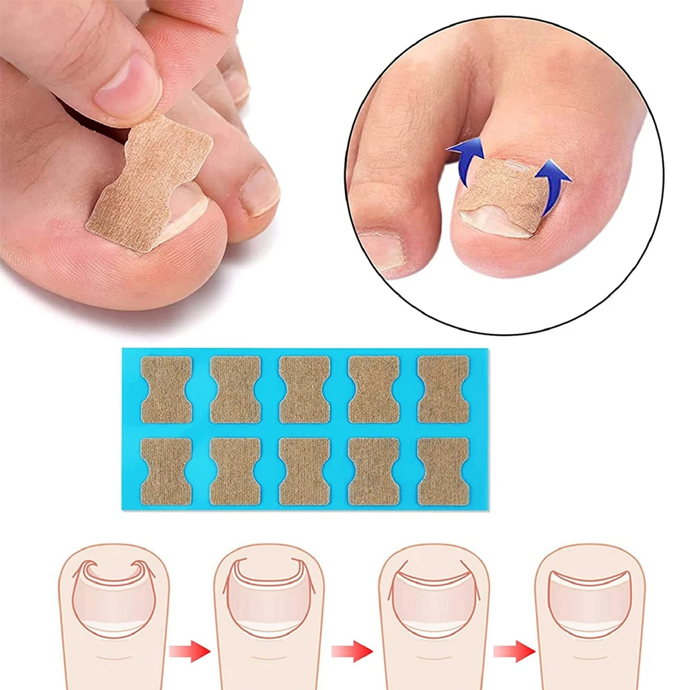 Ingrown Toenail Tools Set Ingrown Toenail Correction Patch Stickers Corrector Pedicure Tool Ingrown Toe Nail Treatment Foot Care