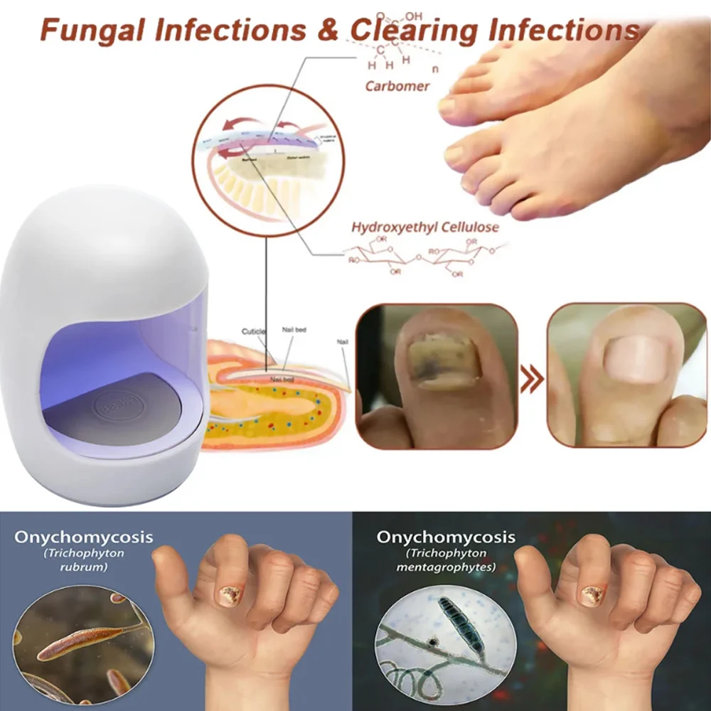 Nail Fungus Laser Treatment Device Fingernail Fungus Treat Onychomycosis Therapy Effectively Remove Onychomycosis Grow Toe Nail