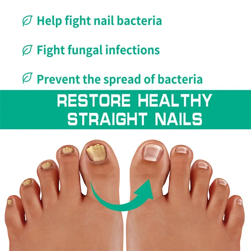 Nail Fungus Treatment Serum Toe Fungal Repair Products Hand Foot Care Removal Gel Anti Infection Onychomycosis Paronychia