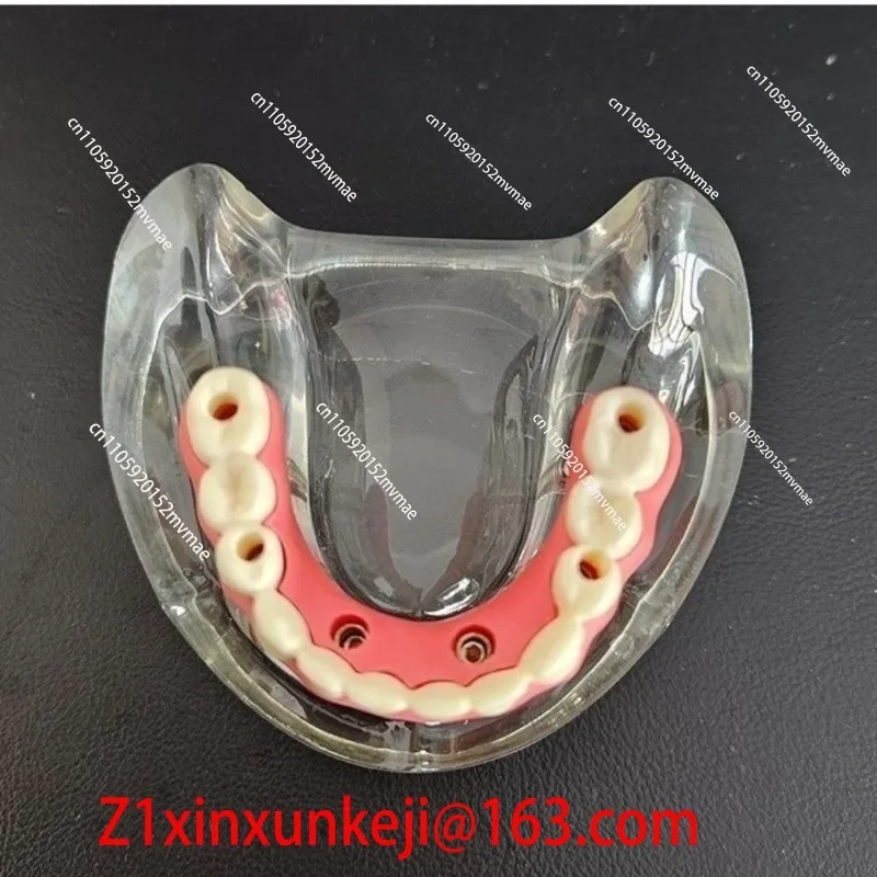 Oral Model Bridge Restoration Implant Dental Simulation Demonstration Simulation Teaching Tool