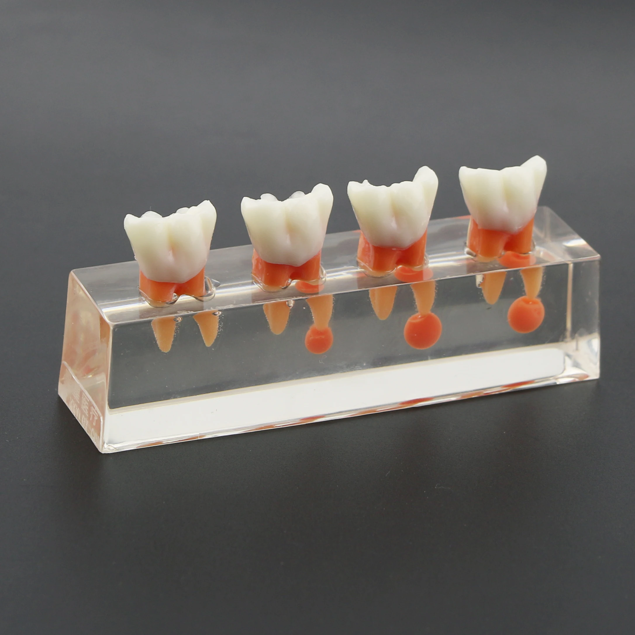 Dental Teeth Model M4018 Endodontic Treatment 4-Stage Molar Root Canal Caries For Studying Teaching