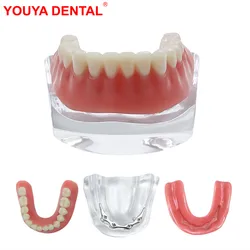 Lower Dental Teeth Model Implant Restoration Bridge Removable Transparent Overdenture Model For Education Teaching Studying Demo