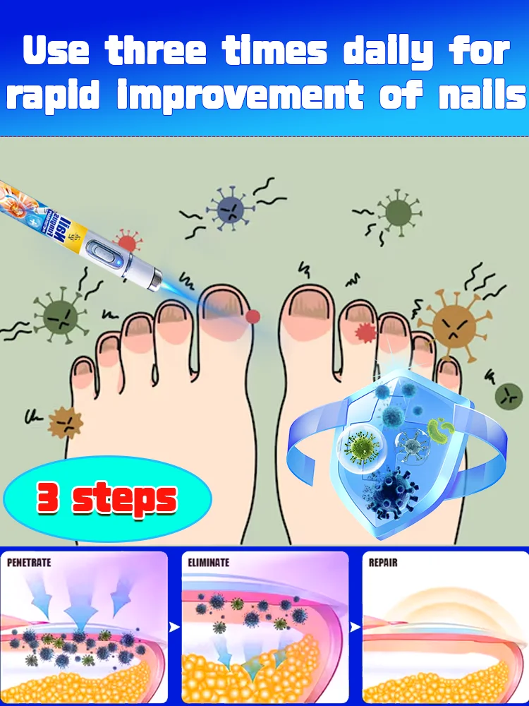 100% efficiënte sterilisatie van blauw licht, Nagelschimmel laser reparatietherapie, Activeer nagelgroei