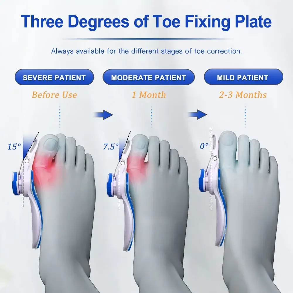 Separador de dedos del pie ajustable, tirantes ortopédicos Hallux Valgus, Corrector alisador de dedos grandes, Corrector de juanetes, alivio de