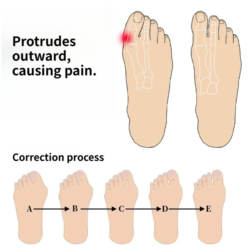 Separador protector de dedos de los pies, Material Corrector de juanete adecuado, alisador de Gel suave, espaciadores, herramienta de cuidado, pequeño, fácil de llevar, 2 uds. = 1 par