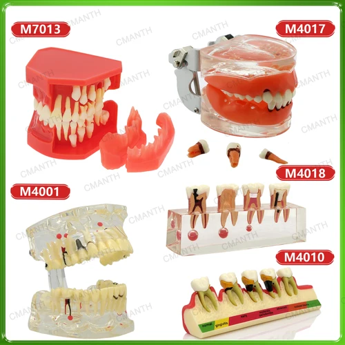 Modelo de enseñanza de dientes dentales, restauración, modelo de diente patológico, estudio de enseñanza Dental extraíble, demostración, entrenamiento de dentista