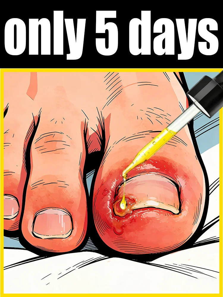 

Eʟɪᴍɪɴᴀᴛᴇ ғᴜɴɢᴀʟ ɴᴀɪʟs Rapid penetration, restoring nails to their natural shine. Say goodbye to fungal nails